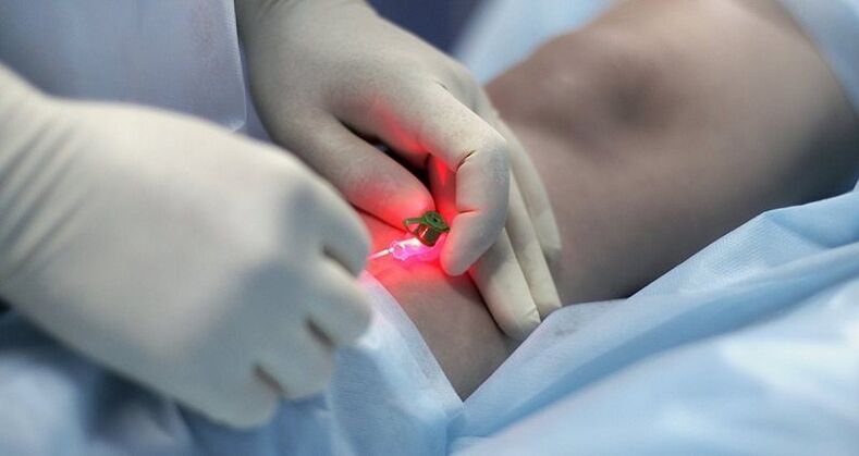 Trajtimi kirurgjik i venave me variçe